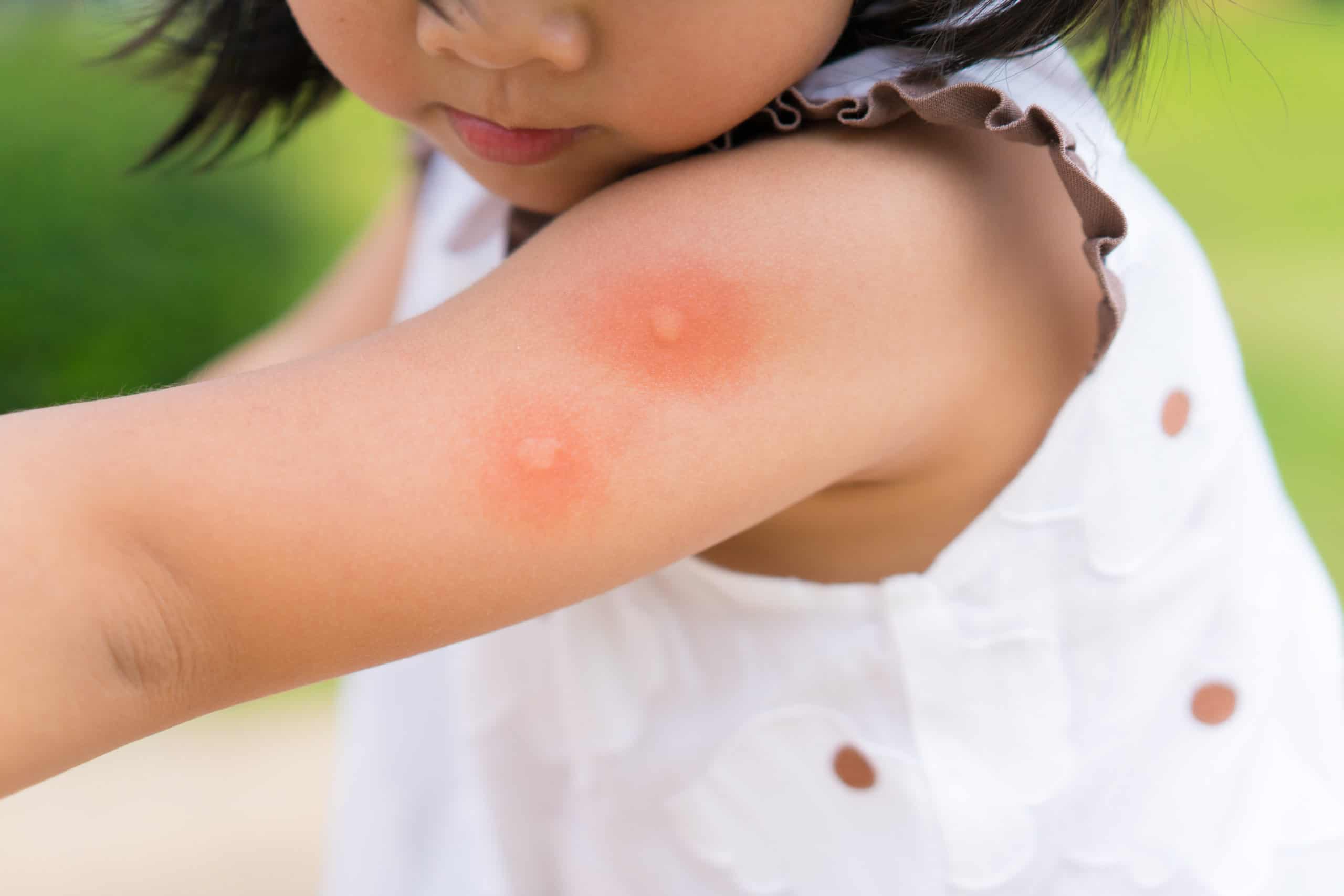 6-mostly-natural-ways-to-prevent-mosquito-bites