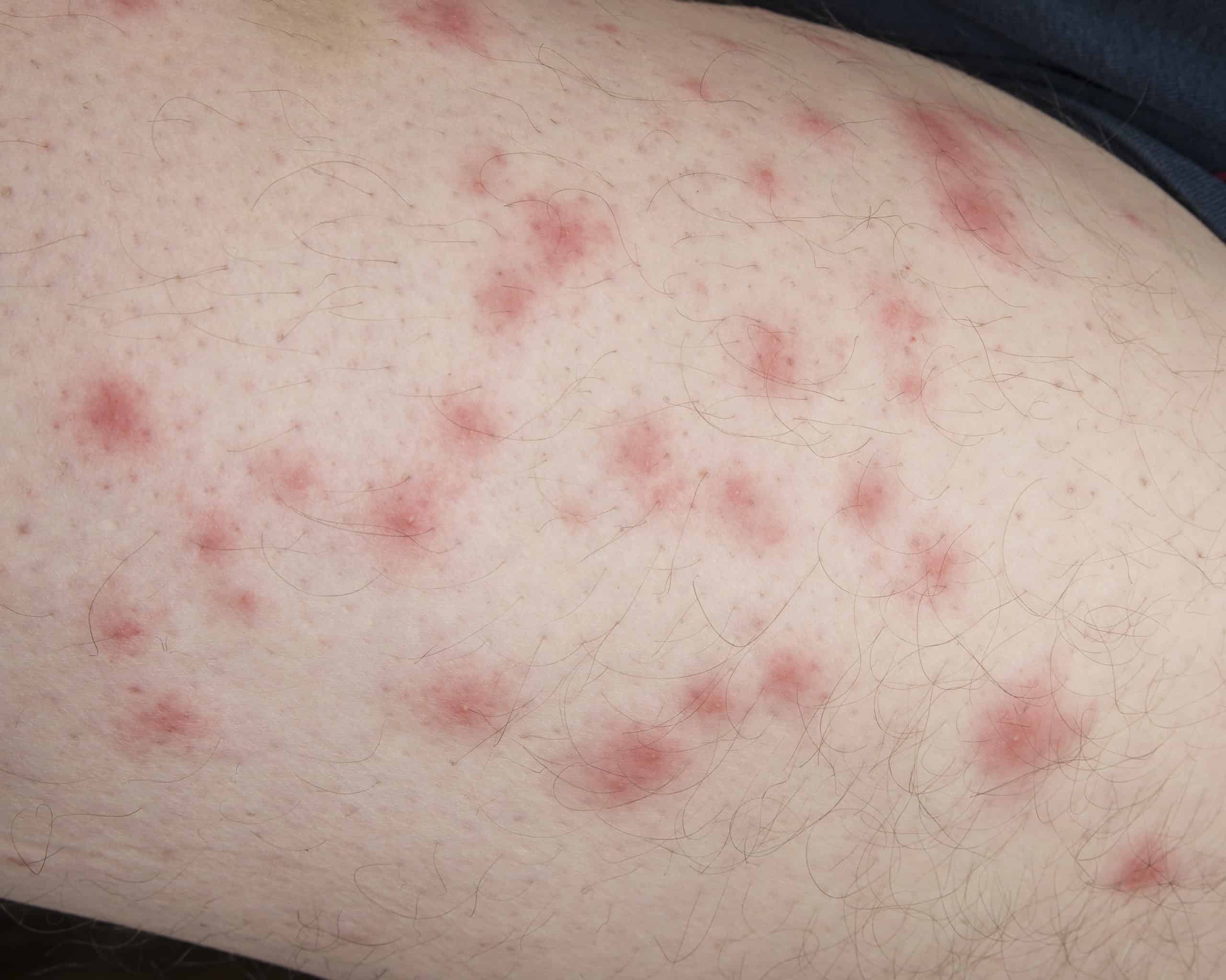 Bites of insect on male body. Bed bugs or flea. - Green Pest Services