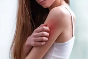 person scratching red irritated skin on upper arm from insect bite irritation