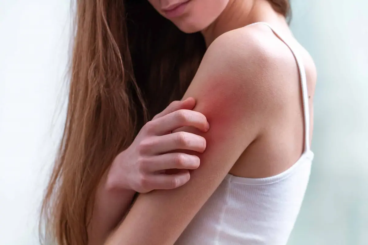 person scratching red irritated skin on upper arm from insect bite irritation