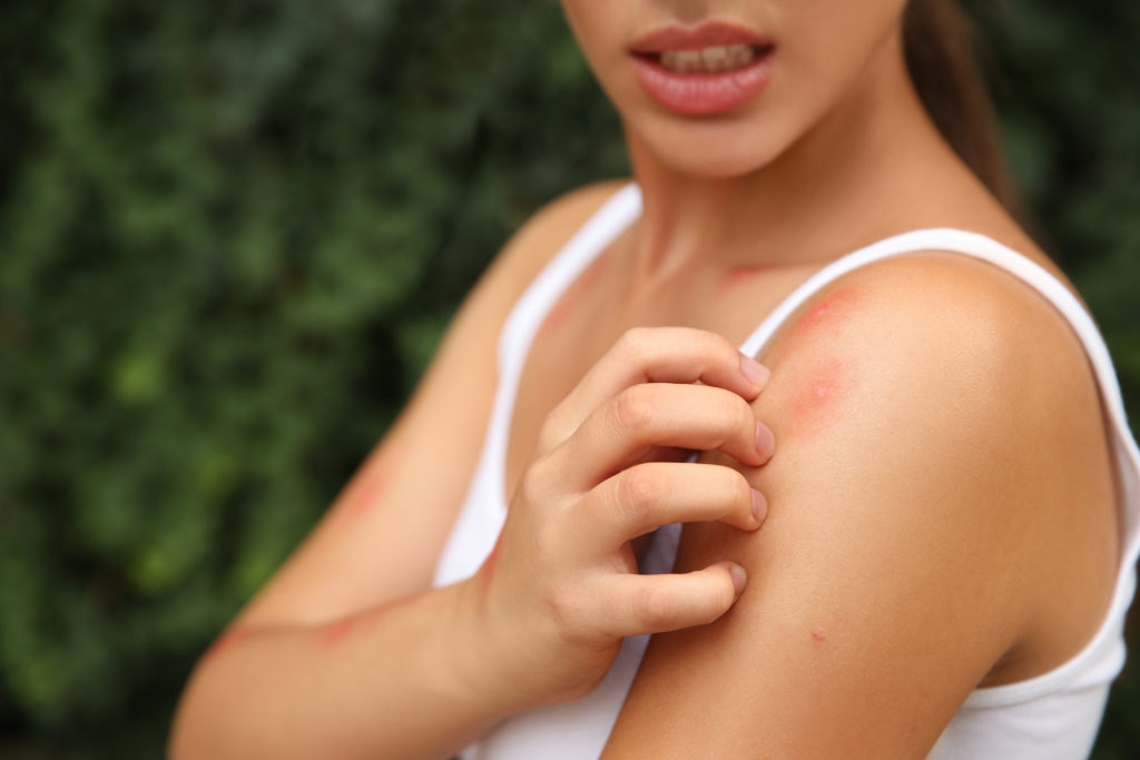 Woman,Scratching,Shoulder,With,Insect,Bite,Outdoors,,Closeup - Green
