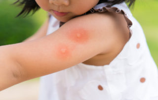 little girl has skin allergies from pests
